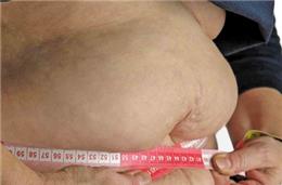 Consulta de cirurgia da obesidade do hospital de Évora recebe 250 novos doentes por ano